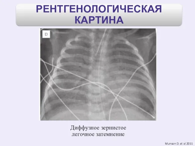 Munson D. et al 2011 Диффузное зернистое легочное затемнение