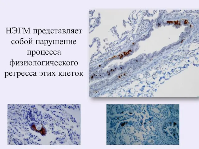 НЭГМ представляет собой нарушение процесса физиологического регресса этих клеток