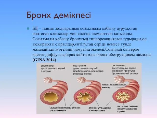 Бронх демікпесі БД – тыныс жолдарының созылмалы қабыну ауруы,оған көптеген клеткалар