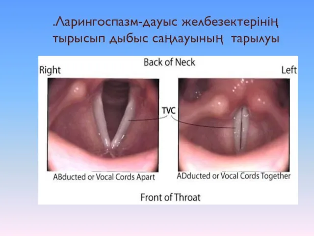 .Ларингоспазм-дауыс желбезектерінің тырысып дыбыс саңлауының тарылуы