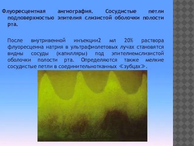 Флуоресцентная ангиография. Сосудистые петли подповерхностью эпителия слизистой оболочки полости рта. После