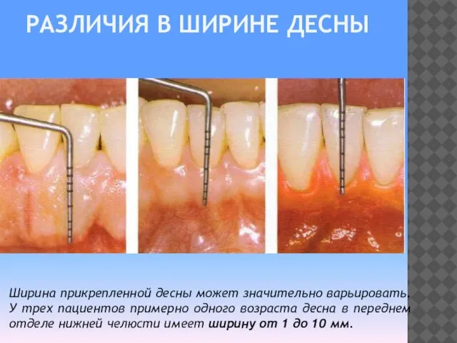 РАЗЛИЧИЯ В ШИРИНЕ ДЕСНЫ Ширина прикрепленной десны может значительно варьировать. У