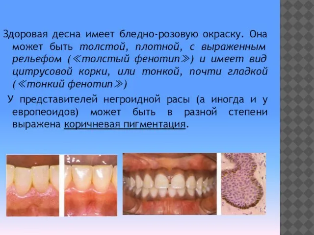 Здоровая десна имеет бледно-розовую окраску. Она может быть толстой, плотной, с