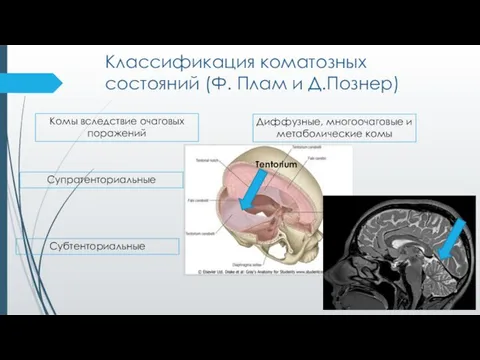 Классификация коматозных состояний (Ф. Плам и Д.Познер) Диффузные, многоочаговые и метаболические