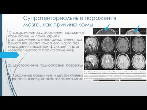 Супратенториальные поражения мозга, как причина комы 1) диффузные двусторонние поражения коры