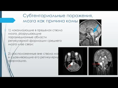 Субтенториальные поражения, мозга как причина комы 1) локализующие в пределах ствола