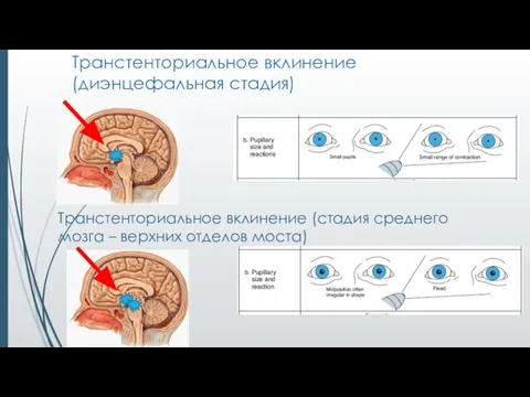 Транстенториальное вклинение (диэнцефальная стадия) Транстенториальное вклинение (стадия среднего мозга – верхних отделов моста)