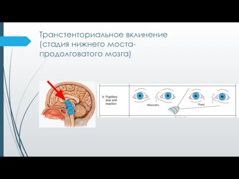 Транстенториальное вклинение (стадия нижнего моста-продолговатого мозга)