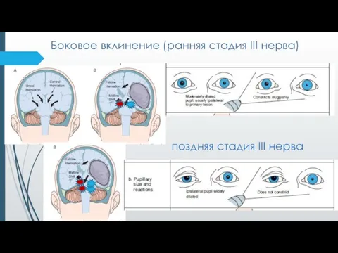 Боковое вклинение (ранняя стадия III нерва) поздняя стадия III нерва