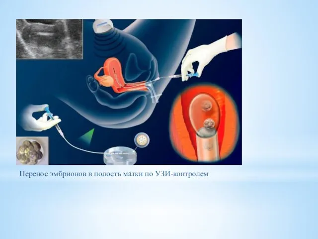 Перенос эмбрионов в полость матки по УЗИ-контролем
