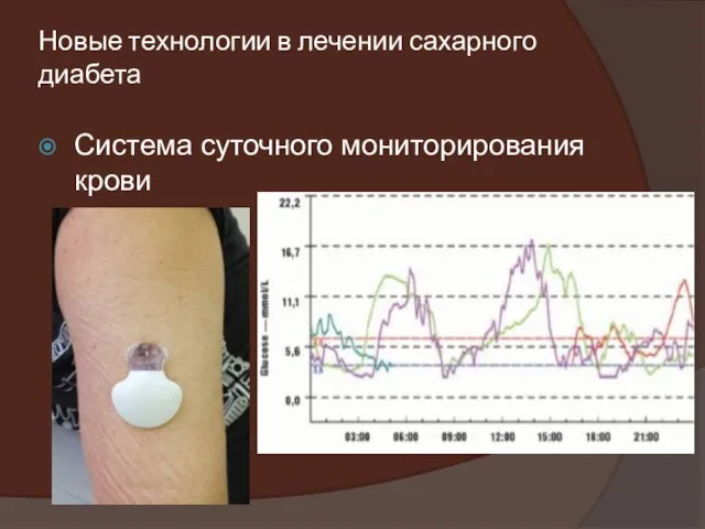 Новые технологии в лечении сахарного диабета Система суточного мониторирования крови