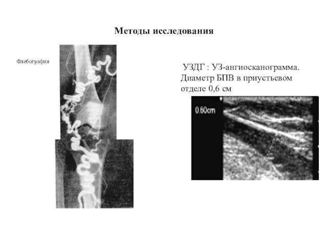 Методы исследования Флебография УЗДГ : УЗ-ангиосканограмма. Диаметр БПВ в приустьевом отделе 0,6 см