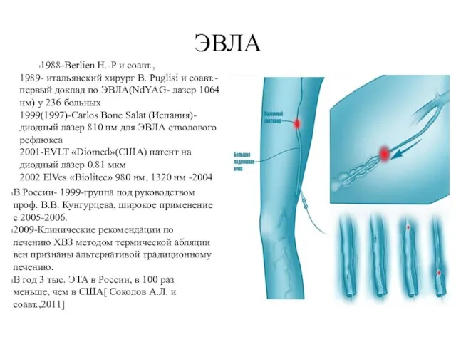 ЭВЛА 1988-Berlien H.-P и соавт., 1989- итальянский хирург B. Puglisi и