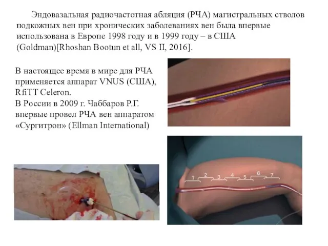 Эндовазальная радиочастотная абляция (РЧА) магистральных стволов подкожных вен при хронических заболеваниях