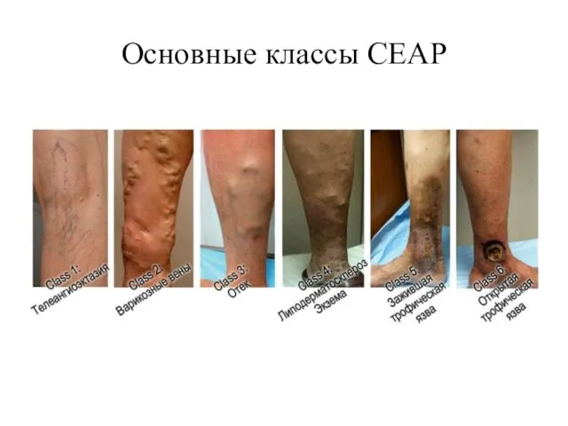 Основные классы CEAP