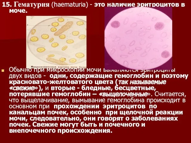 15. Гематурия (haematuria) - это наличие эритроцитов в моче. Обычно при