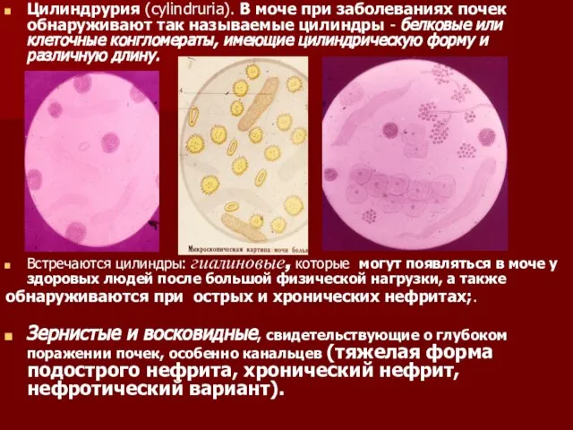 Цилиндрурия (cylindruria). В моче при заболеваниях почек обнаруживают так называемые цилиндры