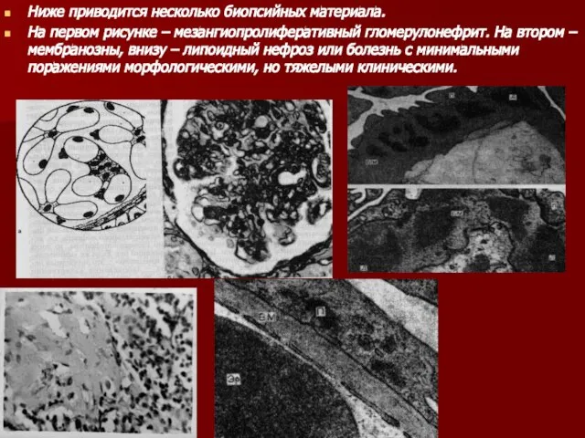 Ниже приводится несколько биопсийных материала. На первом рисунке – мезангиопролиферативный гломерулонефрит.