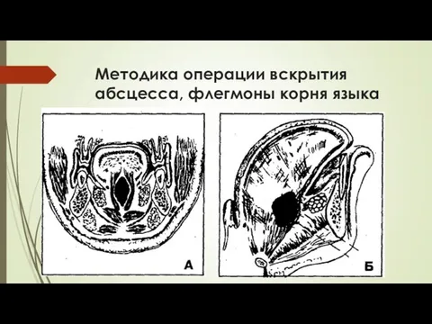 Методика операции вскрытия абсцесса, флегмоны корня языка