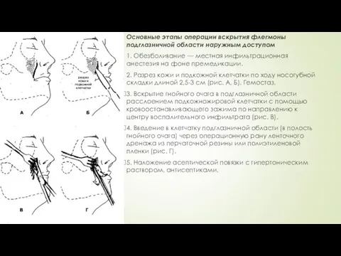 Основные этапы операции вскрытия флегмоны подглазничной области наружиым доступом 1. Обезболивание