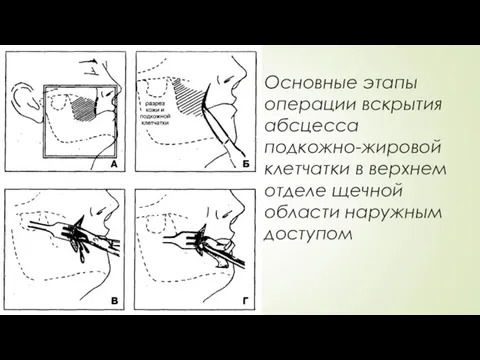 Основные этапы операции вскрытия абсцесса подкожно-жировой клетчатки в верхнем отделе щечной области наружным доступом