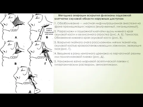 Методика операции вскрытия флегмоны подкожной клетчатки скуловой области наружным доступом 1.