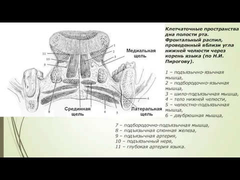 Клетчаточные пространства дна полости рта. Фронтальный распил, проведенный вблизи угла нижней