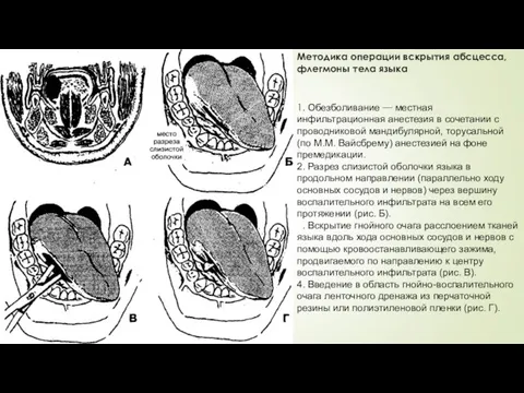 Методика операции вскрытия абсцесса, флегмоны тела языка 1. Обезболивание — местная