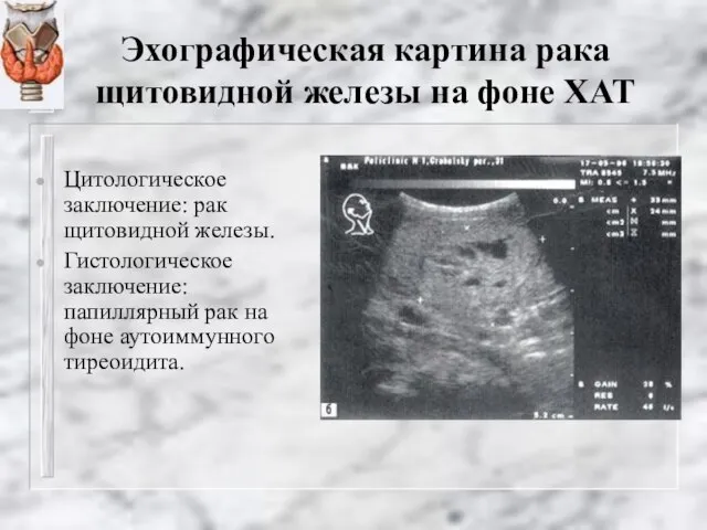 Эхографическая картина рака щитовидной железы на фоне ХАТ Цитологическое заключение: рак