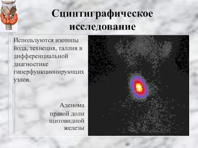 Сцинтиграфическое исследование Аденома правой доли щитовидной железы Используются изотопы йода, технеция,