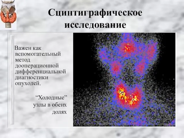 Сцинтиграфическое исследование Важен как вспомогательный метод дооперационной дифференциальной диагностики опухолей. “Холодные” узлы в обеих долях