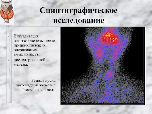 Сцинтиграфическое исследование Визуализация остатков железы после предшествующих оперативных вмешательств, дистопированной железы.