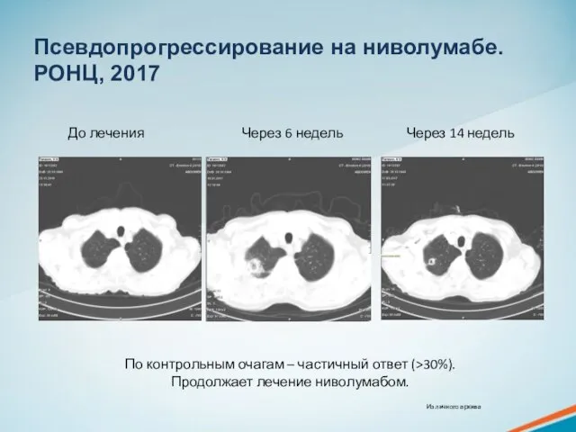 Псевдопрогрессирование на ниволумабе. РОНЦ, 2017 По контрольным очагам – частичный ответ