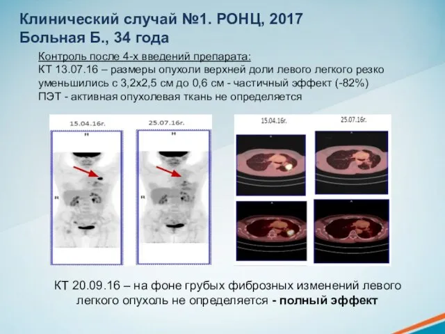 Контроль после 4-х введений препарата: КТ 13.07.16 – размеры опухоли верхней