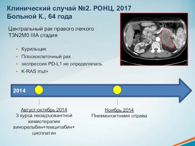 Клинический случай №2. РОНЦ, 2017 Больной К., 64 года Центральный рак