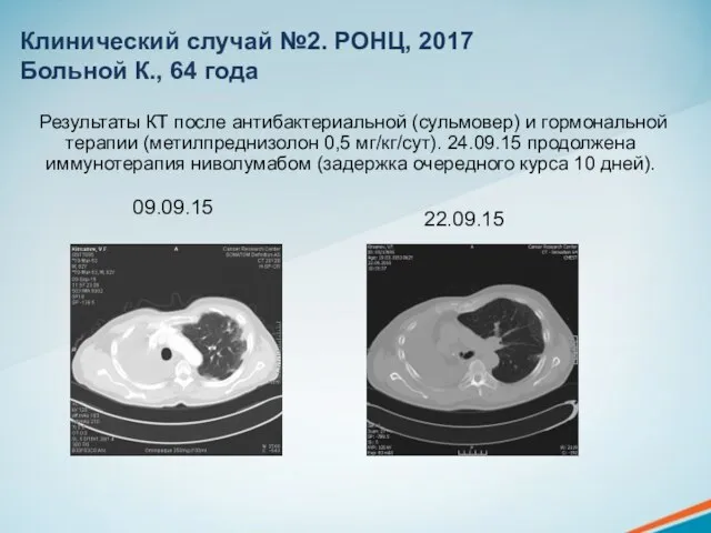 Результаты КТ после антибактериальной (сульмовер) и гормональной терапии (метилпреднизолон 0,5 мг/кг/сут).