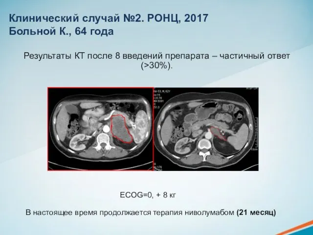 Результаты КТ после 8 введений препарата – частичный ответ (>30%). ECOG=0,