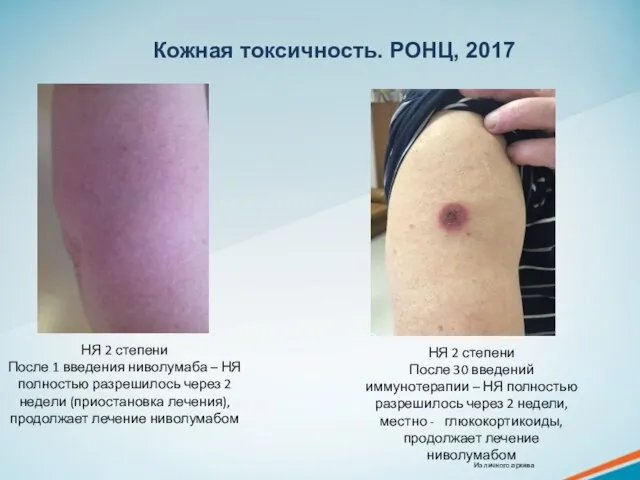 Кожная токсичность. РОНЦ, 2017 НЯ 2 степени После 1 введения ниволумаба