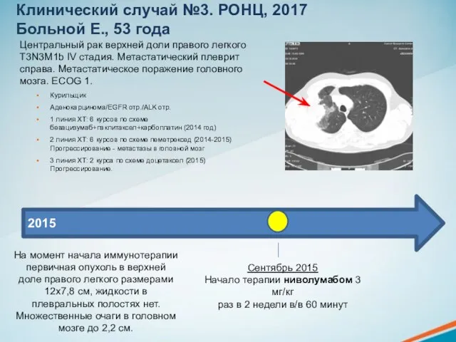 Клинический случай №3. РОНЦ, 2017 Больной Е., 53 года Центральный рак