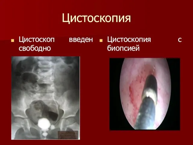 Цистоскопия Цистоскоп введен свободно Цистоскопия с биопсией