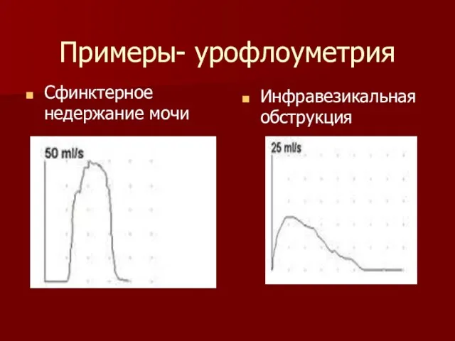 Примеры- урофлоуметрия Инфравезикальная обструкция Сфинктерное недержание мочи