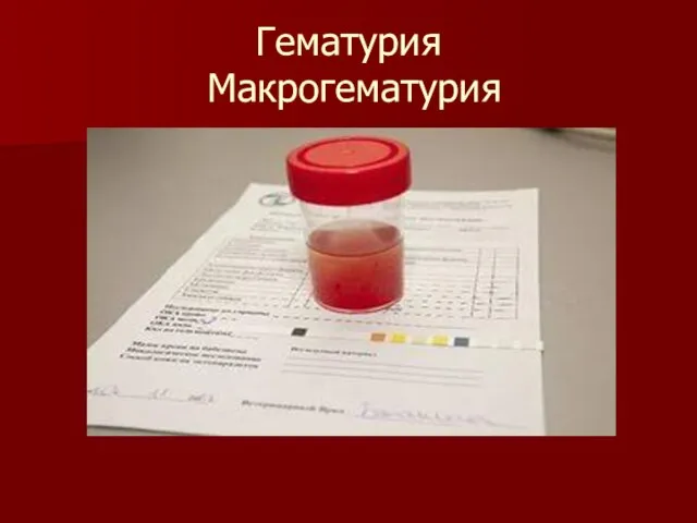 Гематурия Макрогематурия