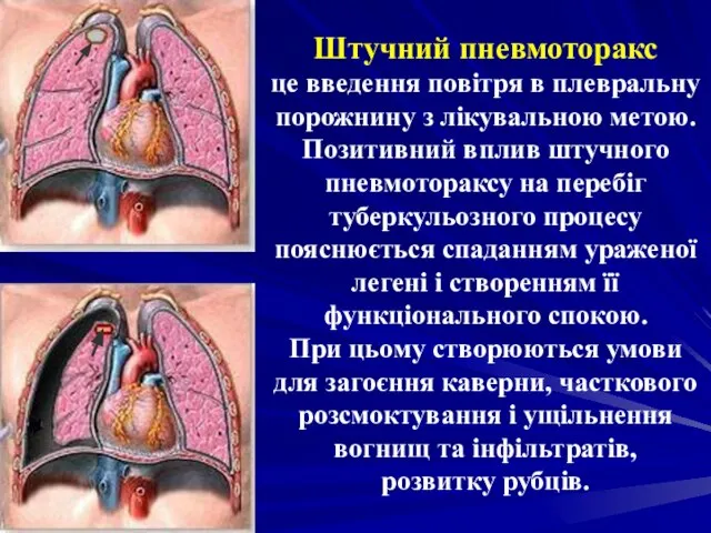 Штучний пневмоторакс це введення повітря в плевральну порожнину з лікувальною метою.