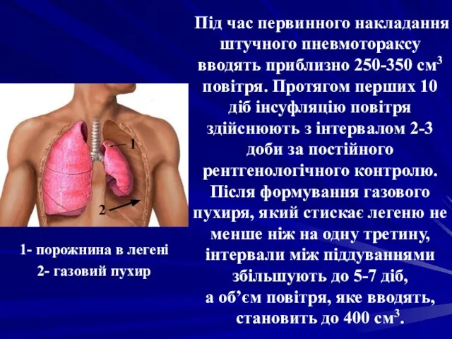 Під час первинного накладання штучного пневмотораксу вводять приблизно 250-350 см3 повітря.