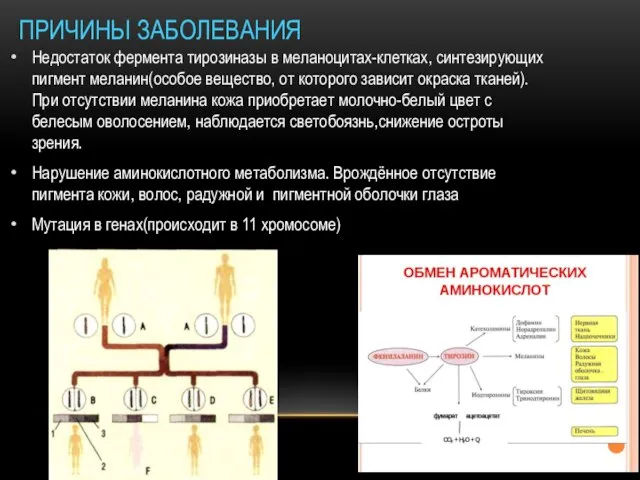 ПРИЧИНЫ ЗАБОЛЕВАНИЯ Недостаток фермента тирозиназы в меланоцитах-клетках, синтезирующих пигмент меланин(особое вещество,