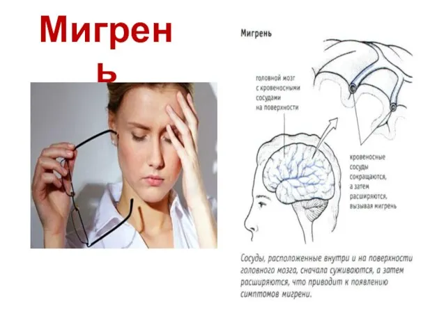 Мигрень