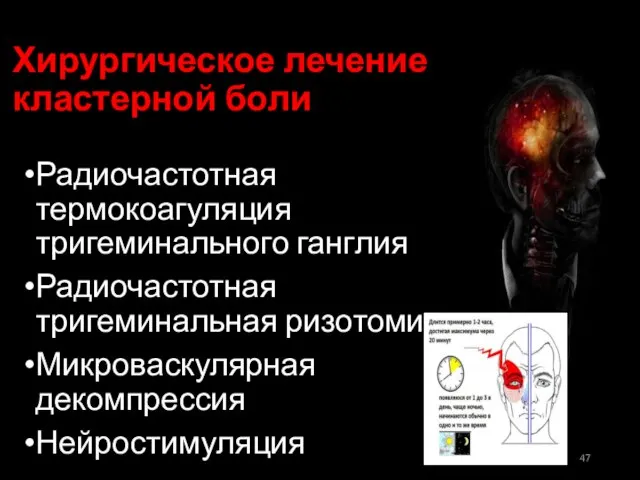 Хирургическое лечение кластерной боли Радиочастотная термокоагуляция тригеминального ганглия Радиочастотная тригеминальная ризотомия Микроваскулярная декомпрессия Нейростимуляция