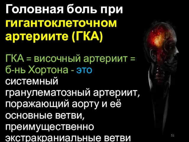 Головная боль при гигантоклеточном артериите (ГКА) ГКА = височный артериит =