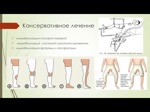 Консервативное лечение иммобилизация гипсовой повязкой; иммобилизация системой скелетного вытяжения; иммобилизация ортезами и аппаратами;