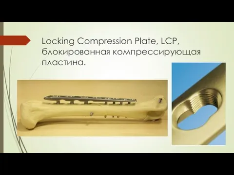 Locking Compression Plate, LCP, блокированная компрессирующая пластина.